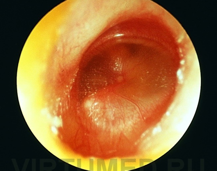 Фантом отоскопии и ухода за ухом