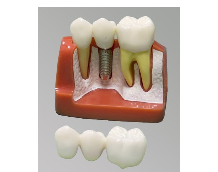 Модель зубного имплантанта